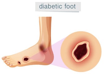 sintomi piede diabetic