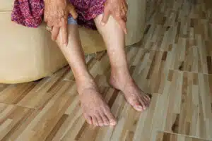 Gambe gonfie negli anziani: cause, sintomi e rimedi Gambe gonfie negli anziani: cause, sintomi e rimedi