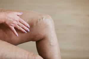 edema gambe anziani