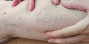gambe gonfie negli anziani